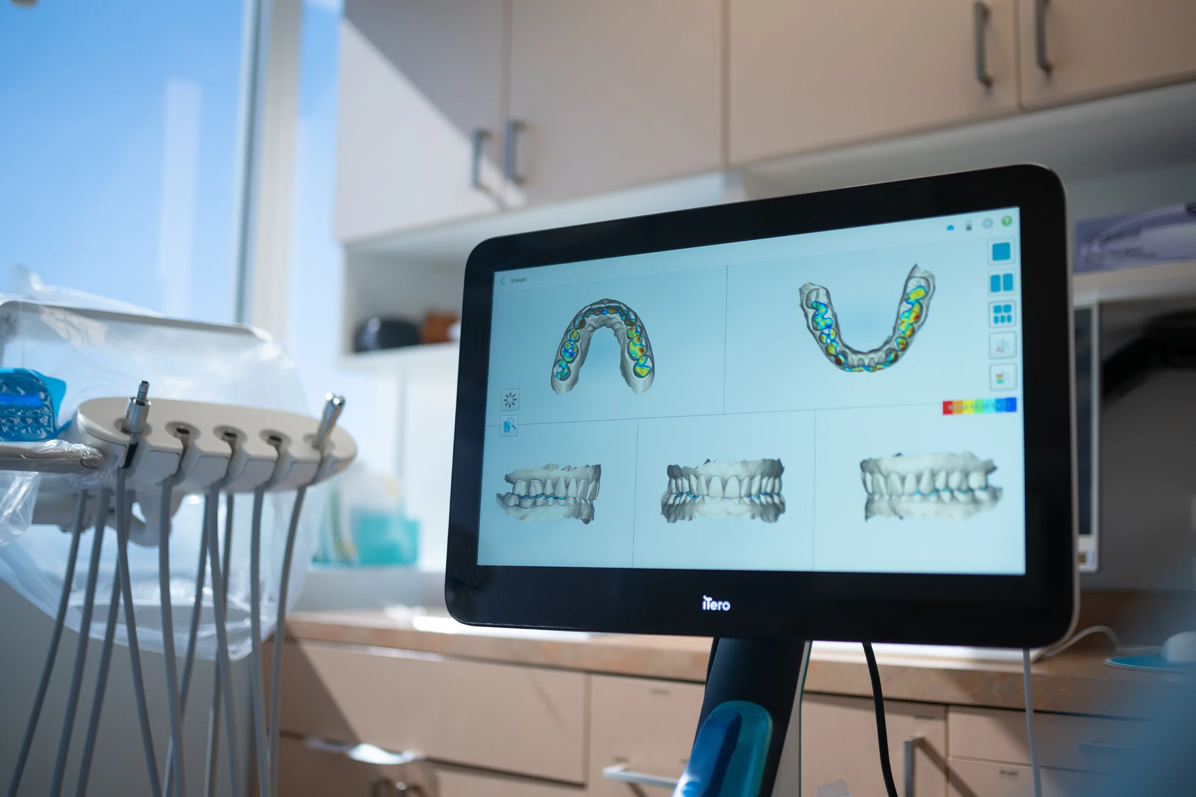 Digital 3D dental scan displayed on an iTero screen at Best Natural Smile