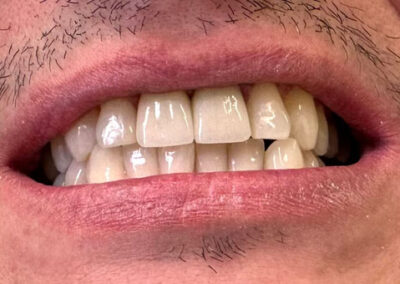 Dental Crown Replacement