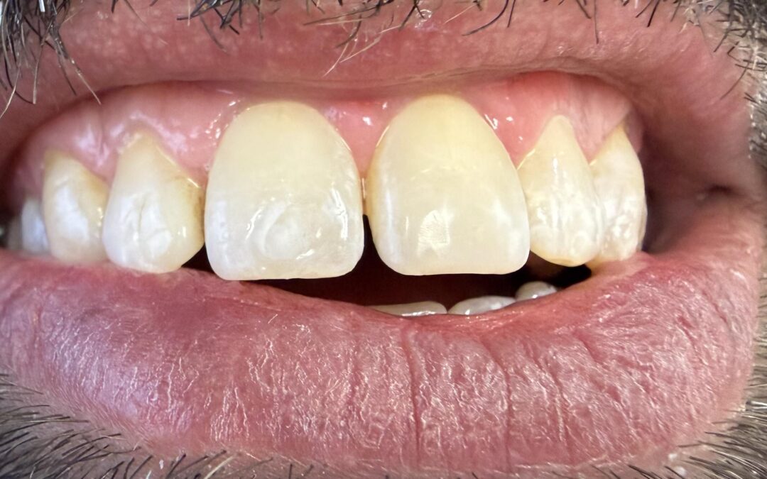 Dental Fillings