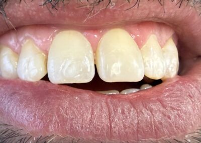 Dental Fillings