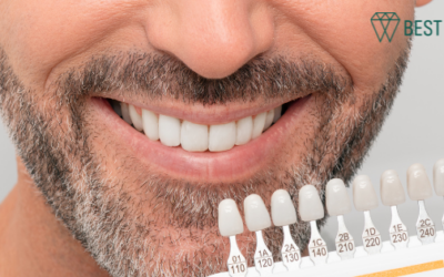 Trust Our Santa Monica Dentist to Help Fix Damaged or Chipped Teeth