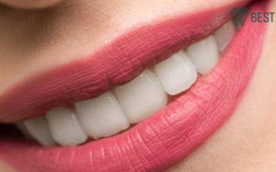 How Digital X-Rays Reveal Whether You Need Whitening