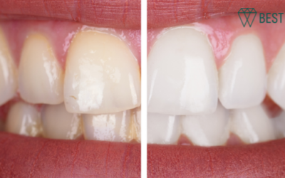 Post Whitening Treatment Recommendations from Your Santa Monica Dentist