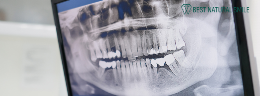 How X-Rays Can Detect Cavities Hiding Between Teeth